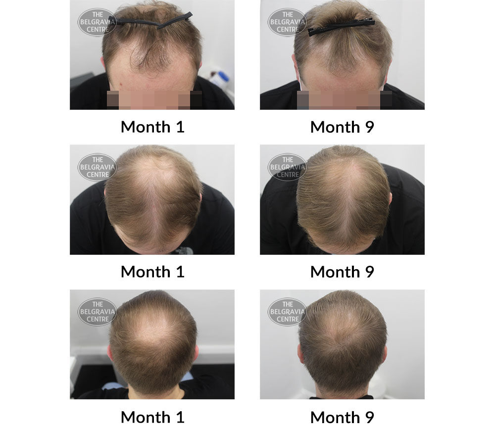 male pattern hair loss the belgravia centre 413298 27 09 2021