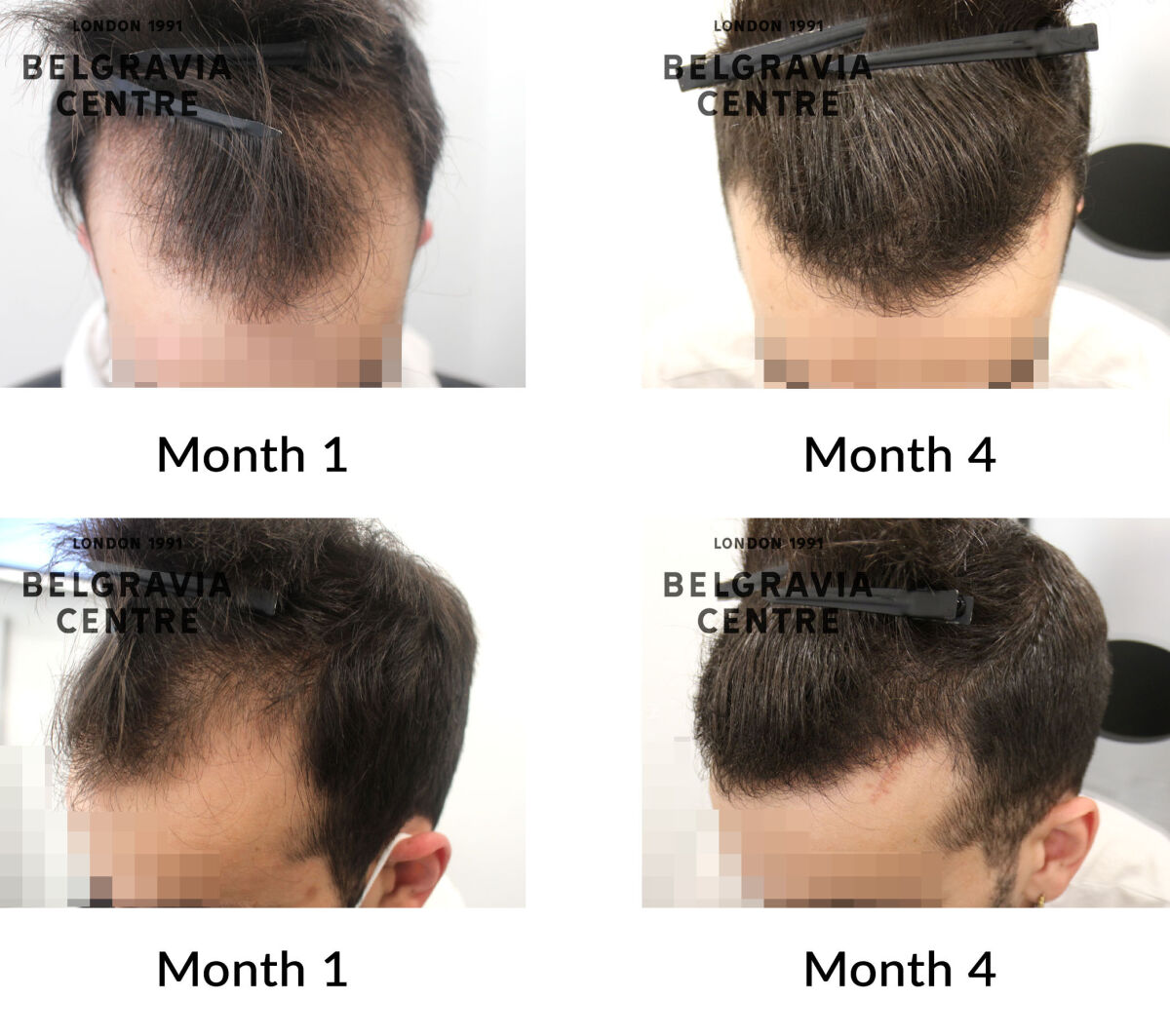 male pattern hair loss the belgravia centre 437907
