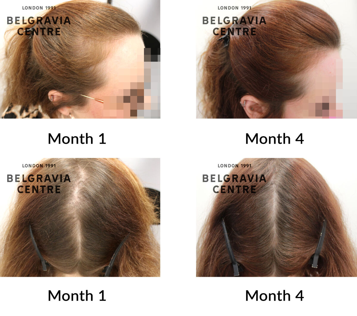 female pattern hair loss the belgravia centre 447514