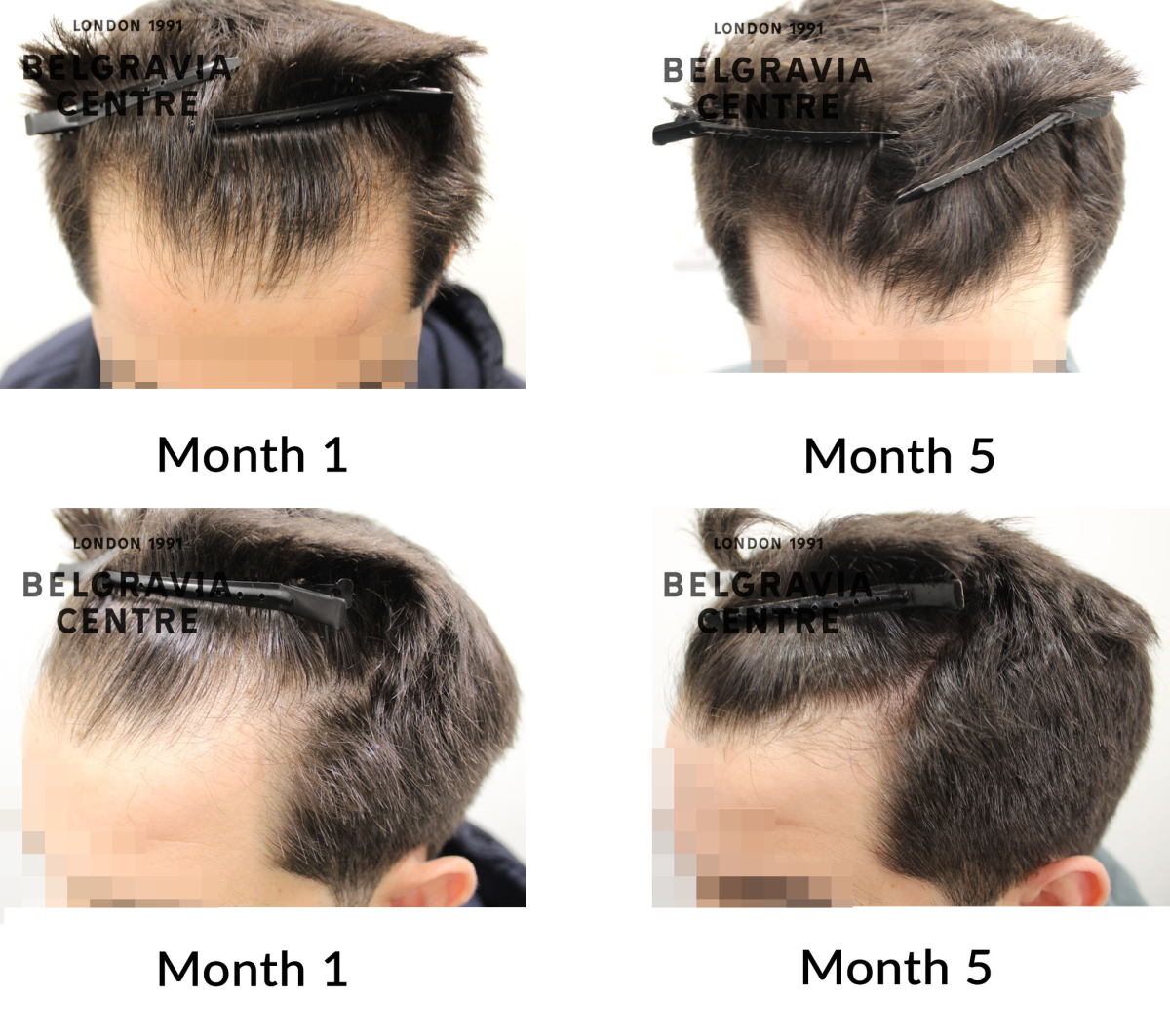 male pattern hair loss the belgravia centre 463874