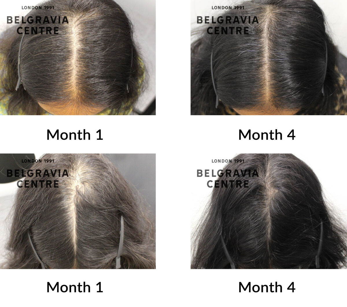 female pattern hair loss the belgravia centre 442504