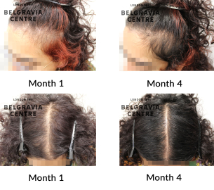 female pattern hair loss the belgravia centre 464144