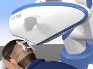 ARTAS hair transplant surgery robot