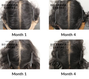 female pattern hair loss and telogen effluvium the belgravia centre 441165