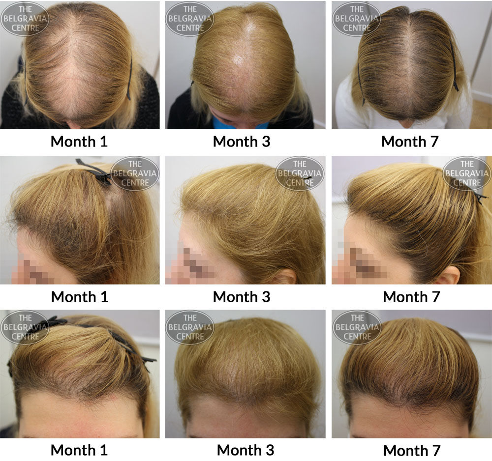 Female Pattern Hair Loss The Belgravia Centre DPC 10 06