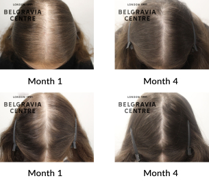 female pattern hair loss and telogen effluvium chronic the belgravia centre 447819