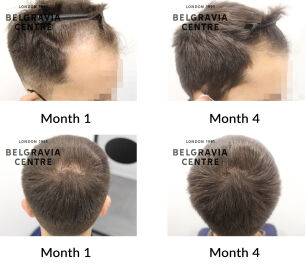 male pattern hair loss the belgravia centre 437078