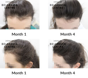 telogen effluvium, female pattern hair loss and hair breakage the belgravia centre 438132