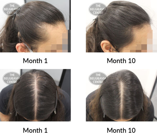 male pattern hair loss the belgravia centre 403511 25 05 2021