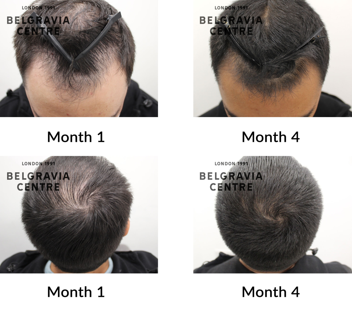 male pattern hair loss the belgravia centre 439449