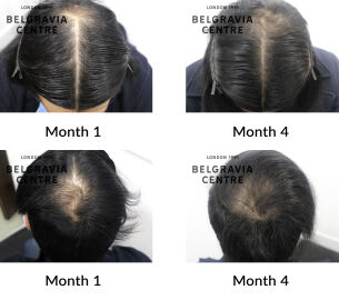 male pattern hair loss the belgravia centre 433590