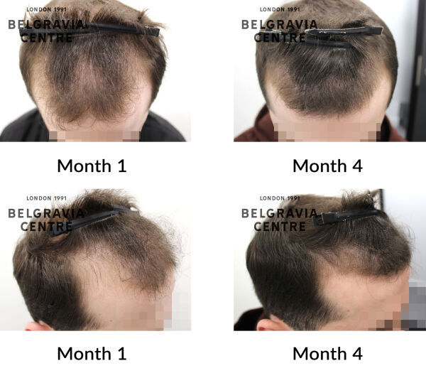 male pattern hair loss the belgravia centre 441767