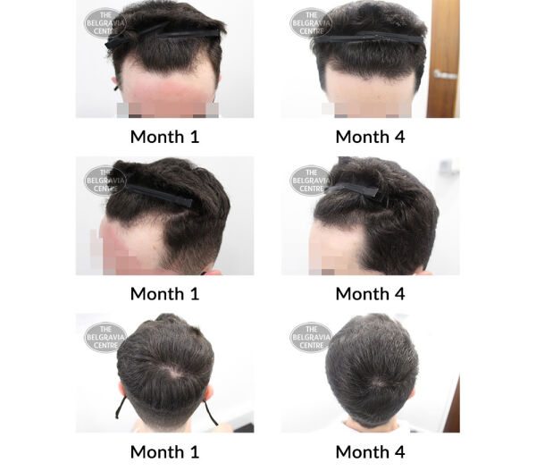 male pattern hair loss the belgravia centre 424051 17 09 2021