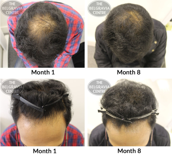 Male Pattern Hair Loss The Belgravia Centre VK 14 05