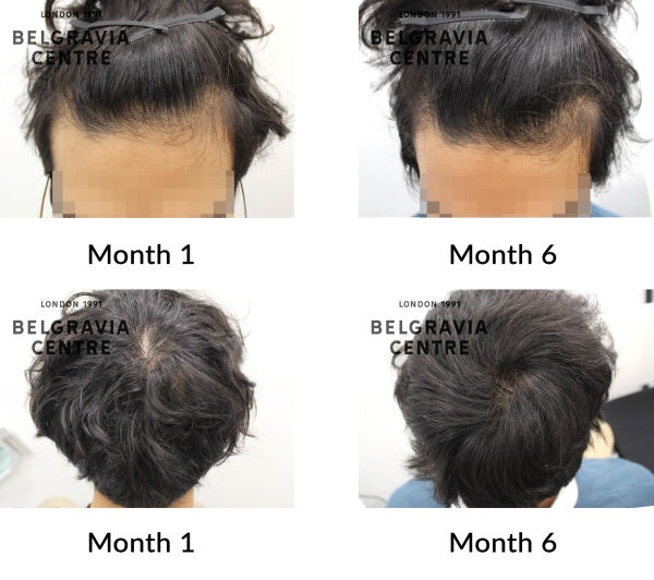 male pattern hair loss the belgravia centre 434132