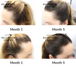 female pattern hair loss and post partum alopecia the belgravia centre 430532