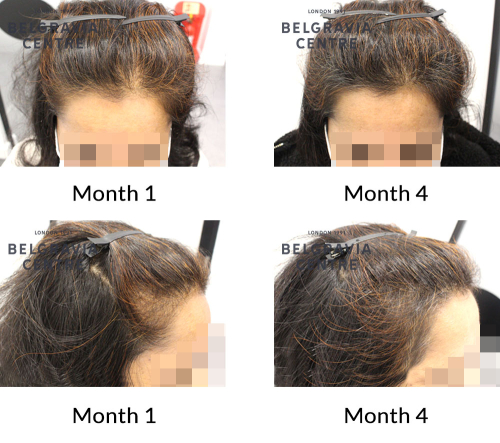 female pattern hair loss the belgravia centre 430537