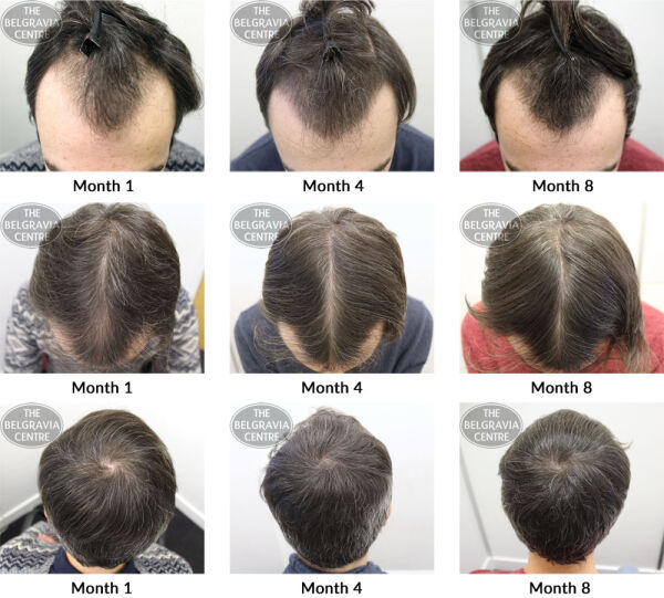 male pattern hair loss the belgravia centre cs 30 03 2017