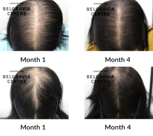 female pattern hair loss the belgravia centre 371672