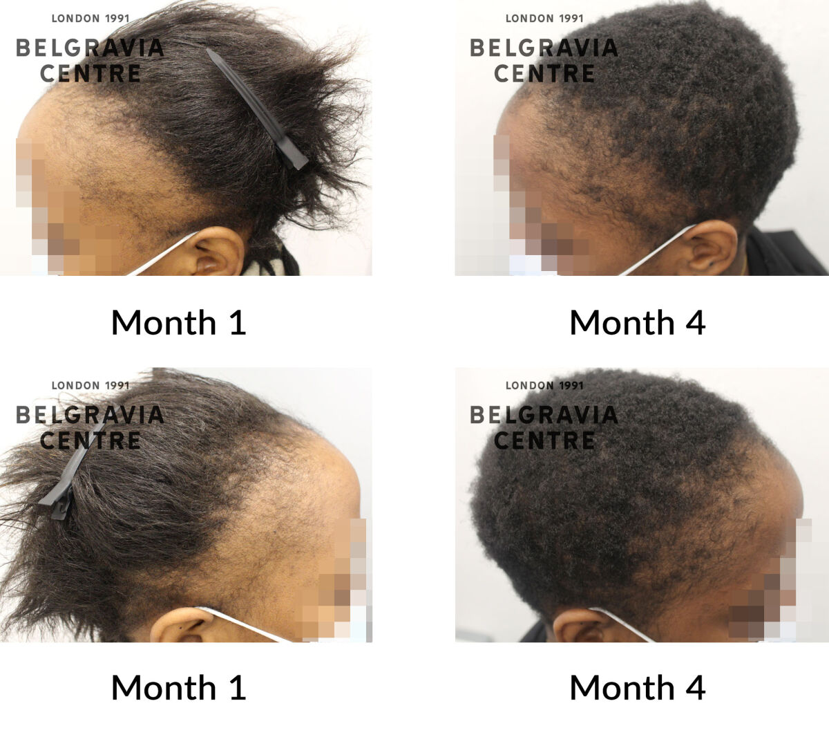 traction alopecia the belgravia centre 433009