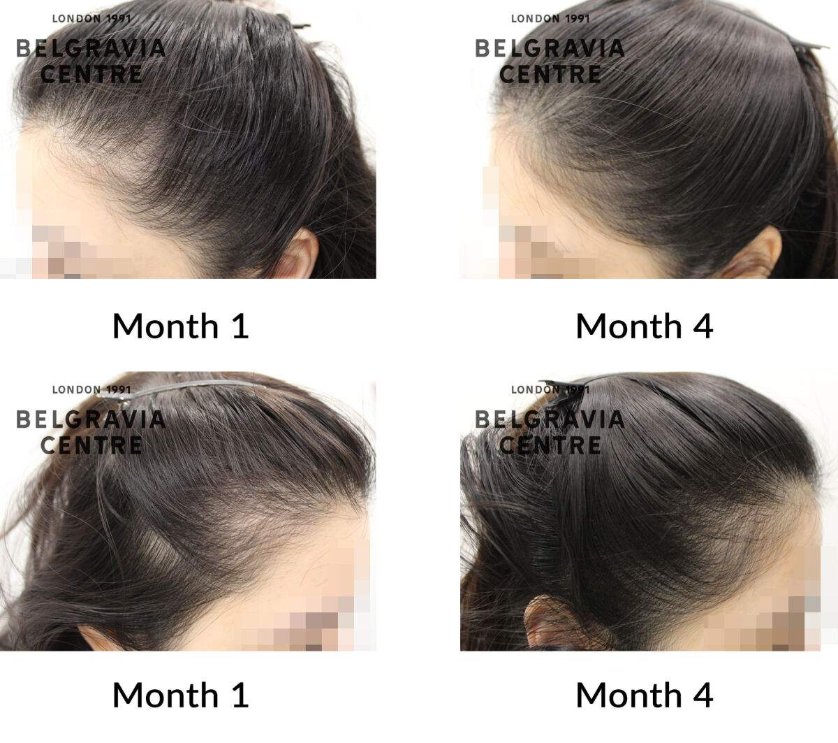 female pattern hair loss the belgravia centre 450530