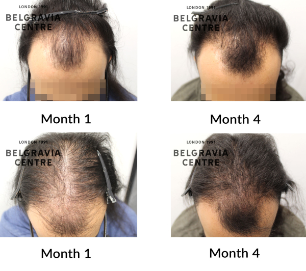 male pattern hair loss the belgravia centre 460940
