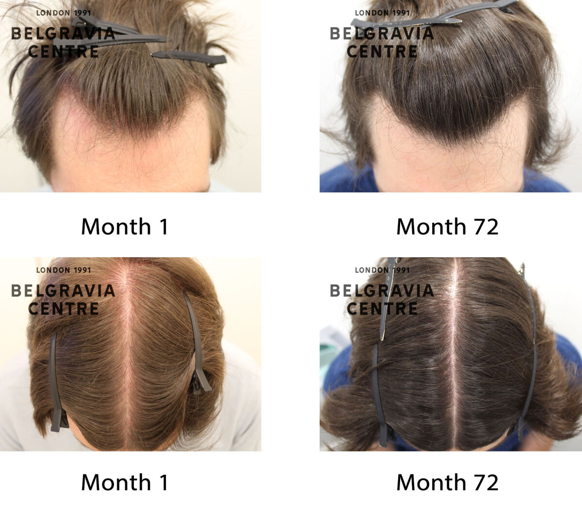 male pattern hair loss the belgravia centre 313323