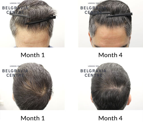 male pattern hair loss the belgravia centre 430755