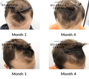 male pattern hair loss the belgravia centre 455693