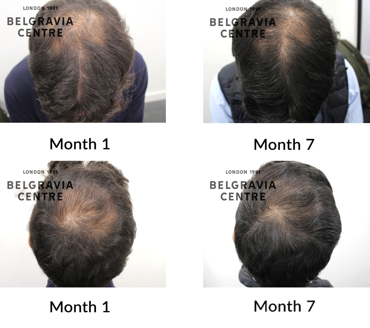 male pattern hair loss the belgravia centre 447331