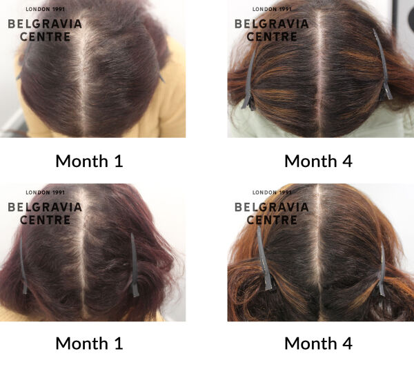 female pattern hair loss the belgravia centre 439639