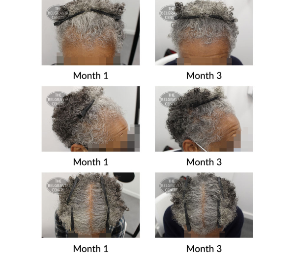 female pattern hair loss the belgravia centre 426713 03 11 2021