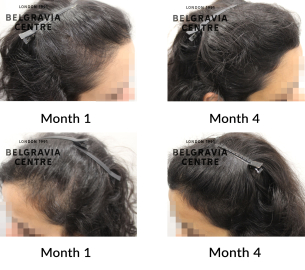 female pattern hair loss the belgravia centre 455524