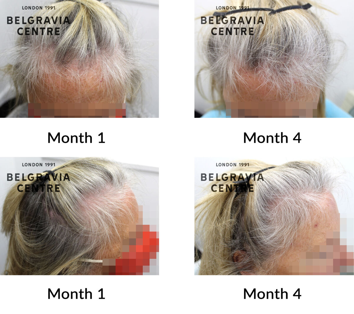 diffuse hair loss and female pattern hair loss the begravia centre 43652