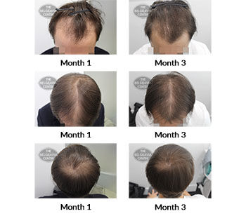 alert male pattern hair loss the belgravia centre 422828 29 07 2021