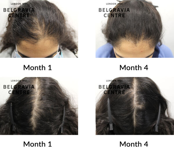 female pattern hair loss the belgravia centre 432304
