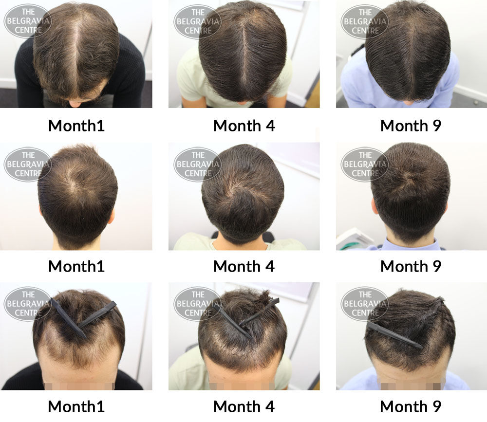 male pattern hair loss the belgravia centre AS 14 02 2019