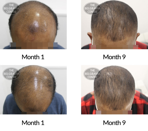 male pattern hair loss the belgravia centre 398115 09 12 2020