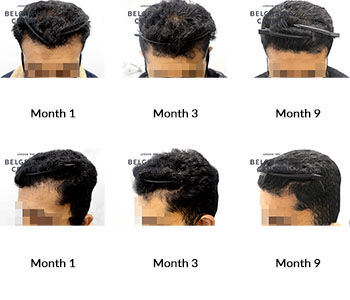 alert male pattern hair loss the belgravia centre 421661 070122