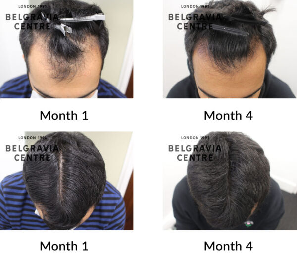 male pattern hair loss the belgravia centre 429877 1024x907