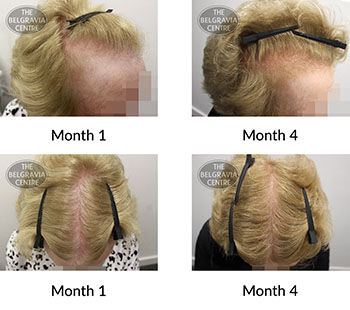 alert female pattern hair loss the belgravia centre 427129 22 11 2021