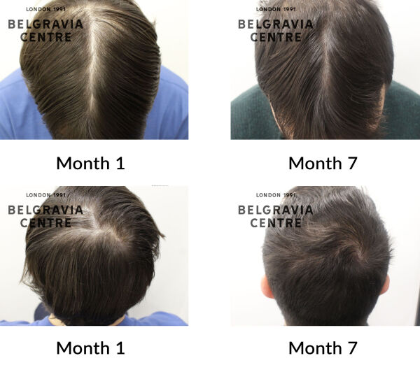 male pattern hair loss the belgravia centre 441486