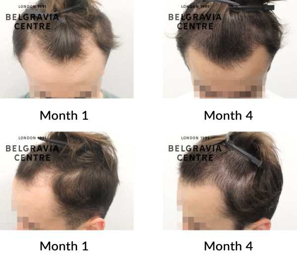 male pattern hair loss the belgravia centre 438562