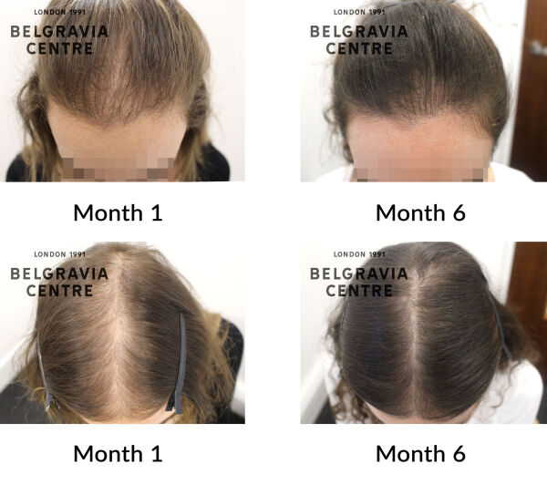 female pattern hair loss and traction alopecia 395315
