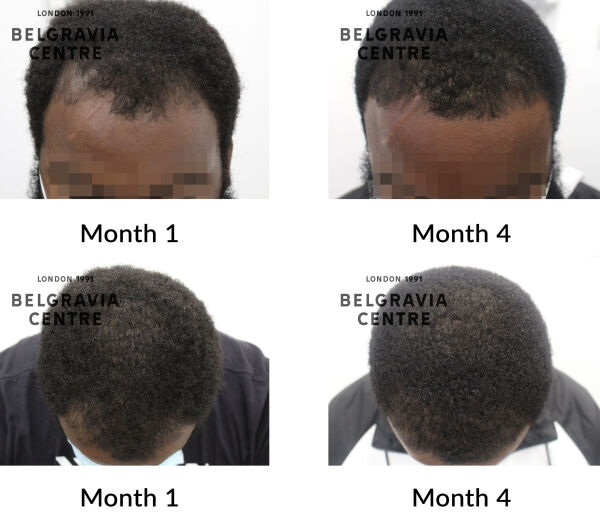 male pattern hair loss the belgravia centre 433769