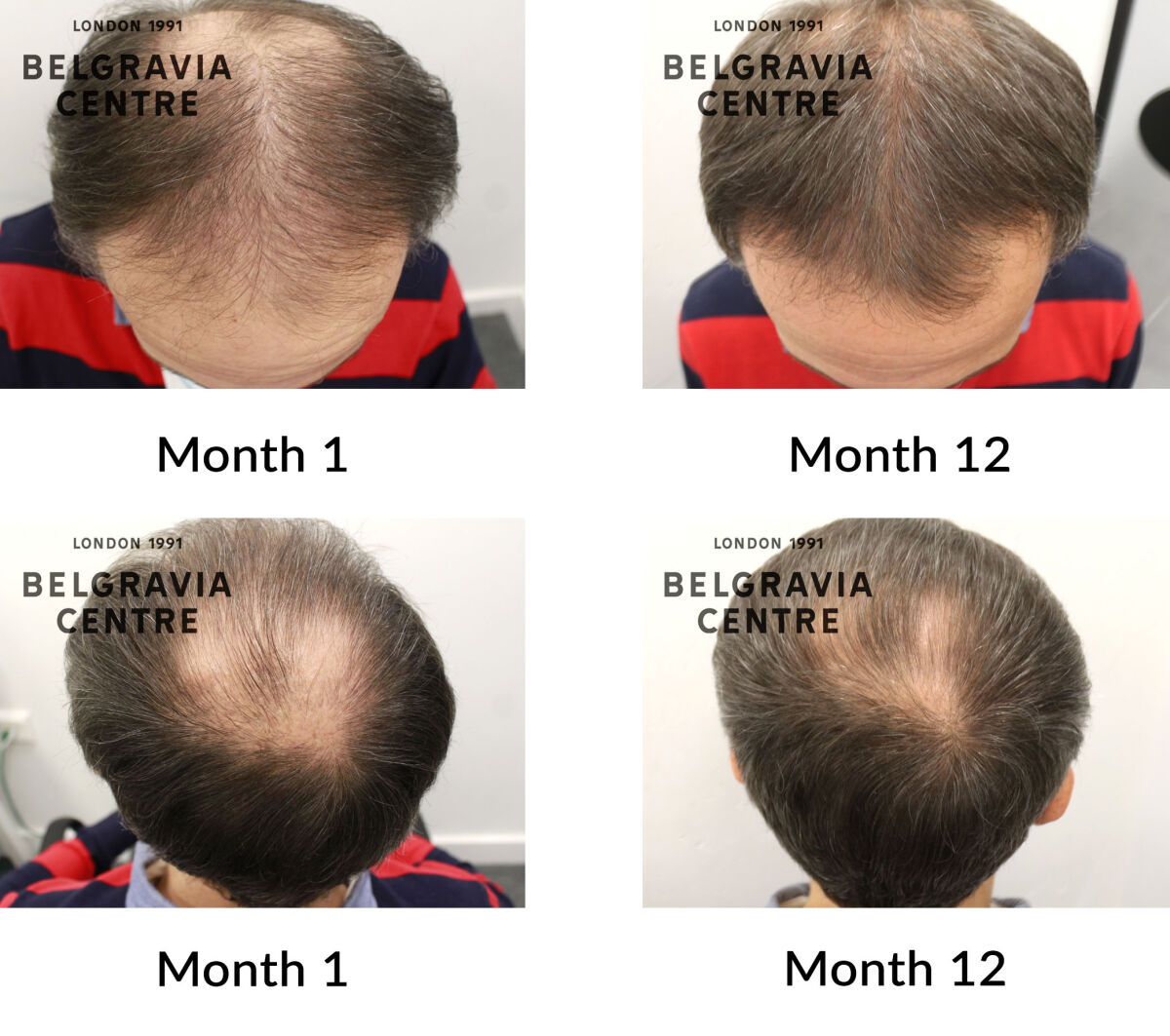 male pattern hair loss the belgravia centre 430618
