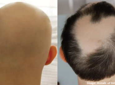 Tofactinib Case Study Man With Alopecia Universalis Regrows Hair