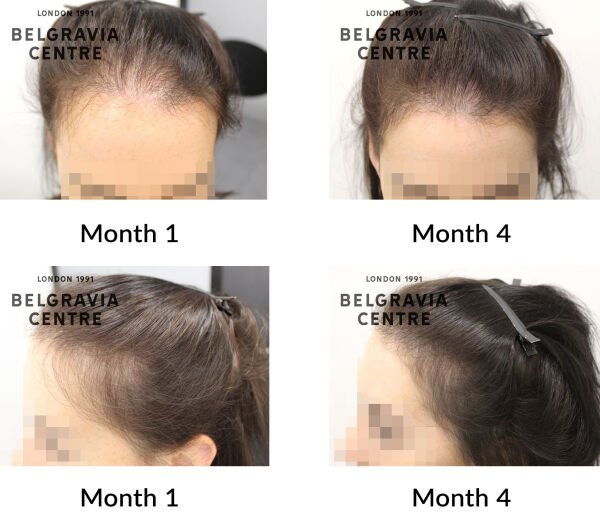 telogen effluvium chronic and female pattern hair loss the belgravia centre 436673