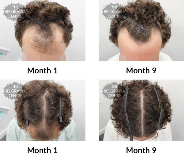 male pattern hair loss the belgravia centre 369815 15 07 2019