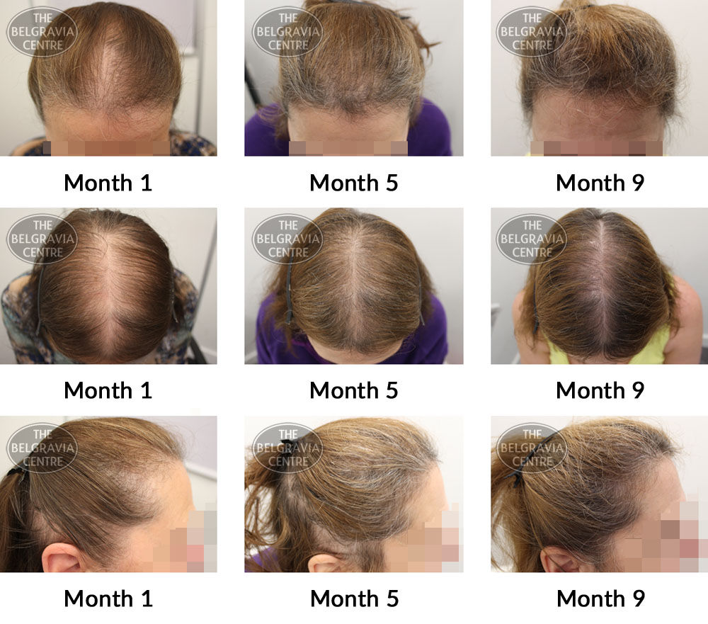 female pattern hair loss and diffuse thinning the belgravia centre 366265 08 04 2019